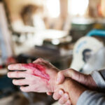 Burns and Explosion Injuries in Construction Accidents